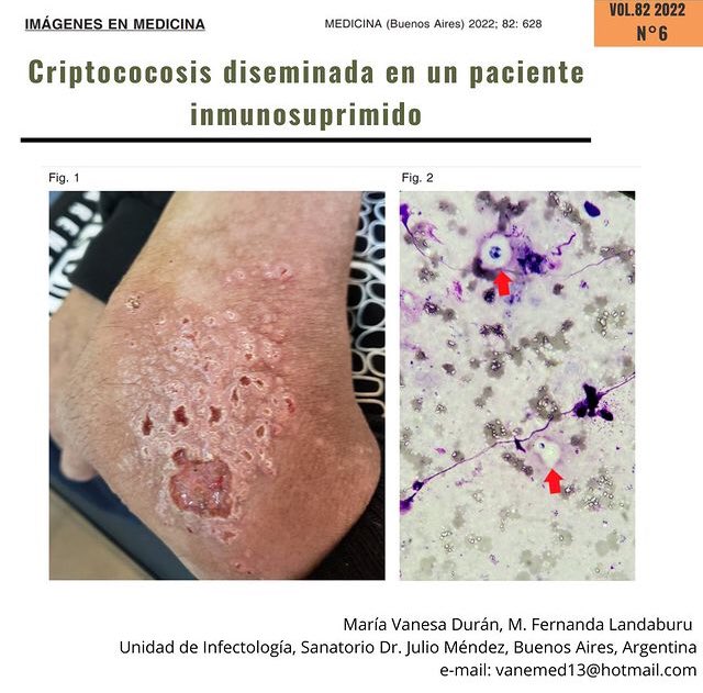 RevMedicinaBA's tweet image. medicinabuenosaires.com/revistas/vol82… @SADI_arg @SPInfectologia @Infectologia_uy @Criptococos #infectologia #inmunosuprimido #criptococosis #dermatology #Microbiology
