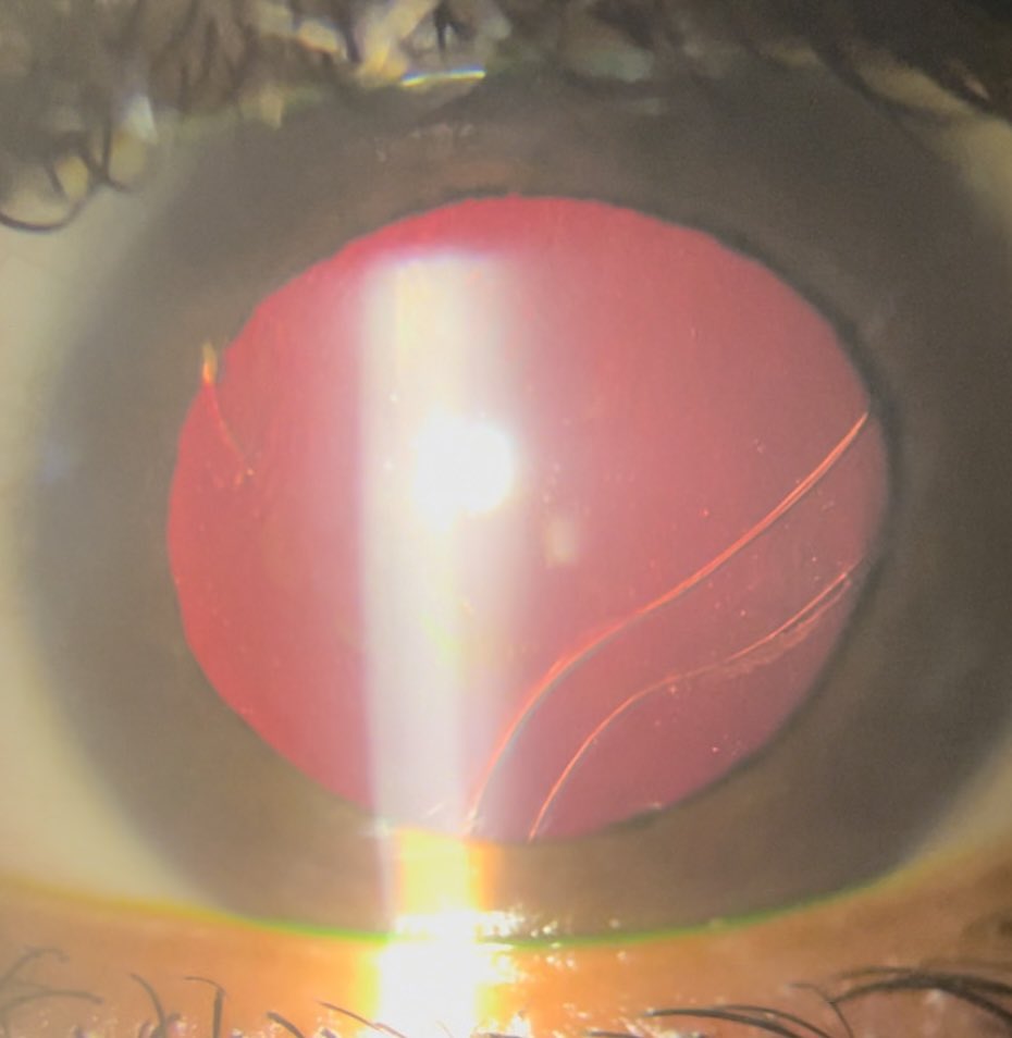 SabrinaKhalil's tweet photo. Haab striae on retro illumination. Stretching of the cornea in primary 👶🏽 congenital glaucoma =  curvilinear breaks in Descemet's membrane. They are typically oriented horizontally or concentric to the limbus #ophtho #eyes #eyetwitter #ophthotwitter #ophthalmology #meded #yo #doc https://t.co/i1iAdwmmuq