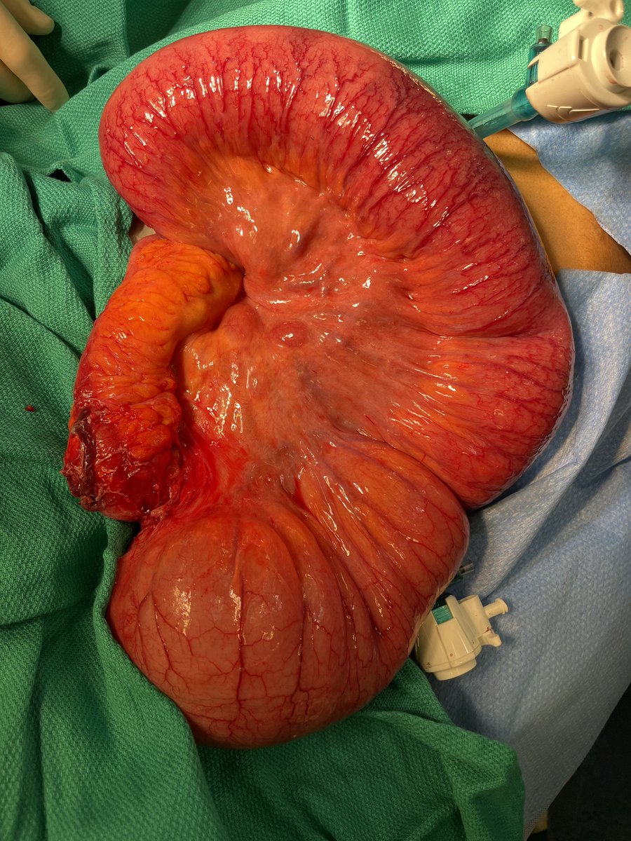 John Monson MD FRCS FACS FASCRS (@johnrtmonsonmd) on Twitter photo WWYD - 25y M with new Dx Crohn’s and obstructed! We find small perforated TI segment with gross upstream dilation. End stoma, anastomosis or join and divert? No steroids! <a href="/HolubarStefan/">Stefan Holubar MD MS</a> <a href="/cmf2x/">Charles Friel</a> <a href="/FicheraAlessand/">Alessandro Fichera</a> <a href="/FergaljFleming/">Fergal Fleming</a> <a href="/ACPGBI/">@ACPGBI</a> <a href="/PhilFleshnerMD/">Phillip Fleshner MD</a> <a href="/FezaRemziMD/">Dr Feza Remzi</a> WWYD - 25y M with new Dx Crohn’s and obstructed! We find small perforated TI segment with gross upstream dilation. End stoma, anastomosis or join and divert? No steroids! <a href="/HolubarStefan/">Stefan Holubar MD MS</a> <a href="/cmf2x/">Charles Friel</a> <a href="/FicheraAlessand/">Alessandro Fichera</a> <a href="/FergaljFleming/">Fergal Fleming</a> <a href="/ACPGBI/">@ACPGBI</a> <a href="/PhilFleshnerMD/">Phillip Fleshner MD</a> <a href="/FezaRemziMD/">Dr Feza Remzi</a>