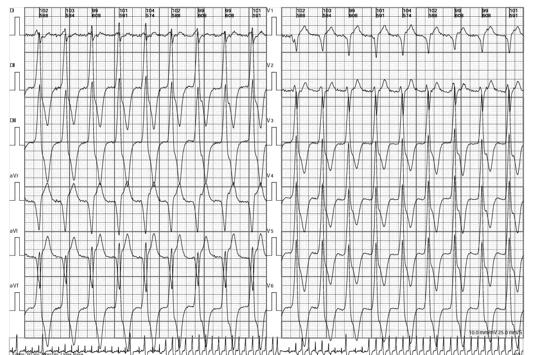 Comite Docencia Investigacion ICR (@comiteicr) on Twitter photo 📌Nuevo Desafio Electrocardiografico ICR💡
➡️Paciente de 63 años, miocardiopatía infiltrativa en estudio y arritmia incesante. Cuál es el diagnóstico probable? (Opciones en Twitt siguiente). @mlanzotti2 <a href="/dchilabert/">Daniela Chilabert</a> <a href="/CamilaAntoniett/">Camila Antonietta</a> 📌Nuevo Desafio Electrocardiografico ICR💡
➡️Paciente de 63 años, miocardiopatía infiltrativa en estudio y arritmia incesante. Cuál es el diagnóstico probable? (Opciones en Twitt siguiente). @mlanzotti2 <a href="/dchilabert/">Daniela Chilabert</a> <a href="/CamilaAntoniett/">Camila Antonietta</a>