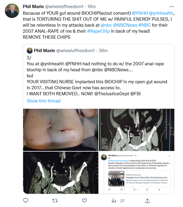 wheeloffreedom1's tweet photo. 1. @YNHH @ynhhealth You have UNDO what YOU DID to me... 
&amp; REMOVE THE GUT WOUND BIOCHIP!

2. #NBC @nbc @NBCNews @NBCNightlyNews You need to save YOUR ASS #RapeChip &amp; do a story on YALE biochipping #Americans w/out consent &amp; sharing data w/CCP.

3. @TheJusticeDept @FBI... HELP ME! https://t.co/uvtVQhQmBN
