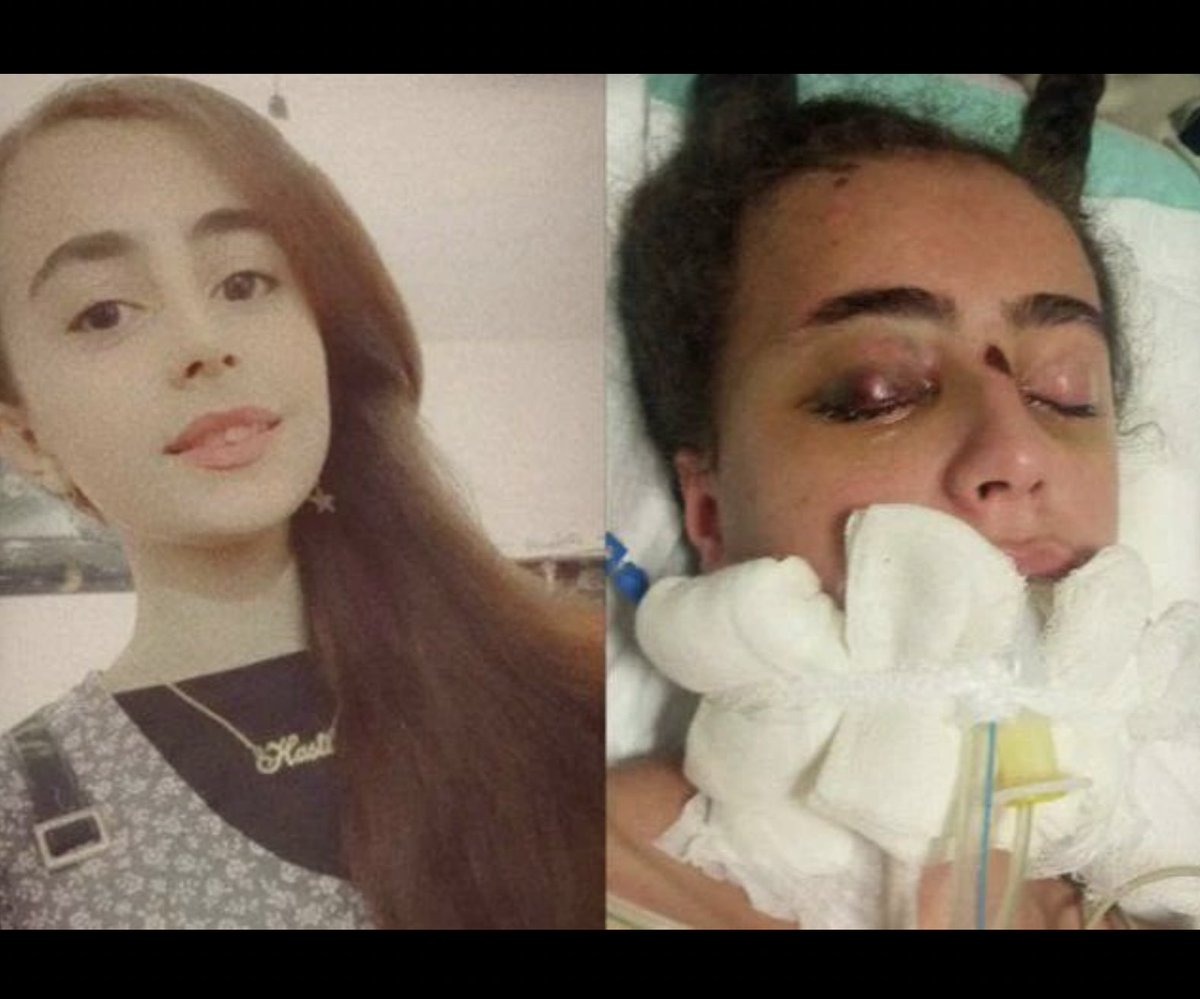 #هستی_حسین‌پناهی نوجوان ۱۶ساله،که دراعتراضات دهگلان در۲۵ دی‌ماه ۱۴۰۱، باضربات باتون سرکوبگران بە شدت مجروح وسپس به بیمارستان کوثرسنندج منتقل شد،همچنان درکما بسرمی‌برد.مسخ شدگی،بی عاطفه گی وبی مغزی؛تعمیم یافته ترین خصایل نیروی سرکوب درهرجغرافیاییست
#IranRevolution #زن_زندگی_آزادی