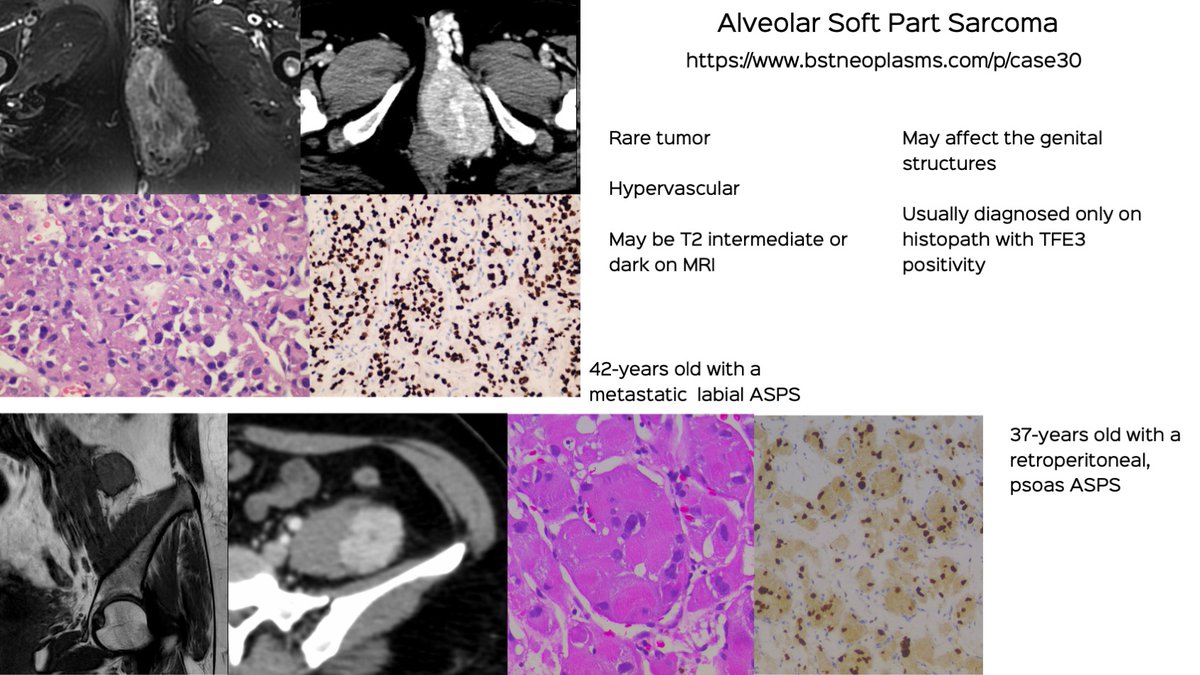 Two Cases of Alveolar Soft Part Sarcoma (ASPS)

A short discussion video

bstneoplasms.com/p/case30

#bstneoplasms #bonetumor #radres  #softtissuesarcoma #ASPS #alveolarsoftpartsarcoma