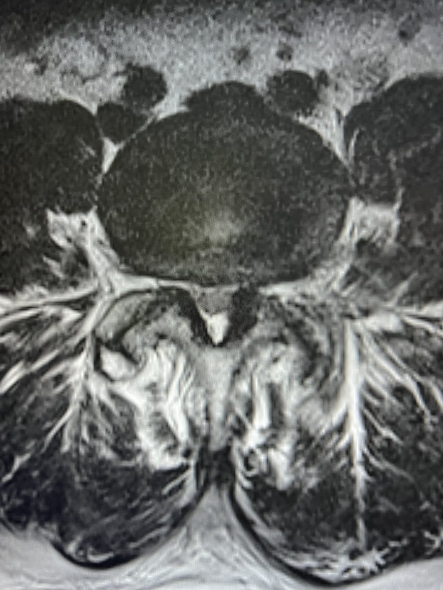 Spondylolisthesis with narrow spinal canal is degenerative and NOT due to spondylolysis