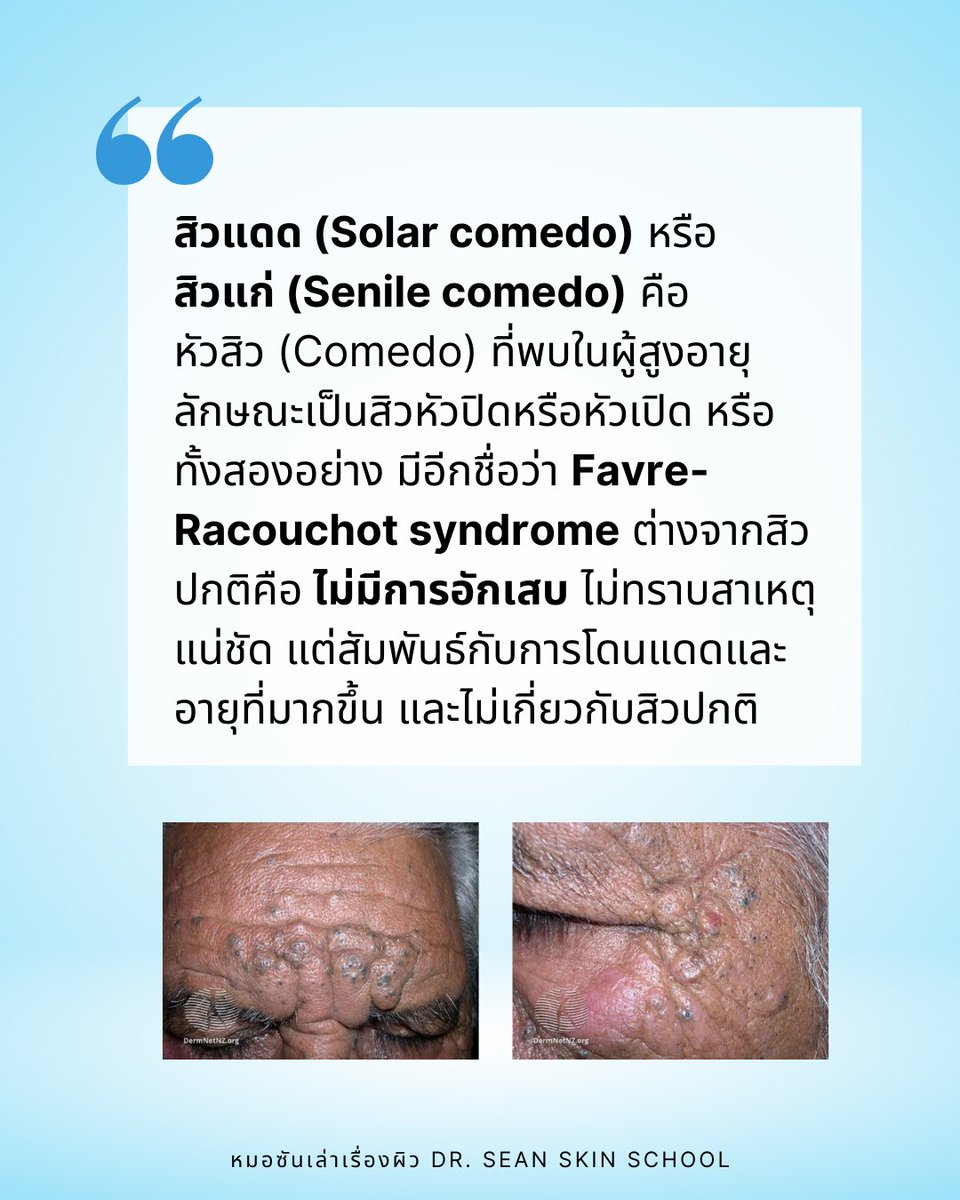 DrSeanSkinSch's tweet photo. สิวแดด สิวที่ไม่ใช่สิว ☀️
#สิวแดด (Solar #comedo) หรือ #สิวแก่ (Senile comedo) 👴🏻 คือหัวสิว (Comedo) ที่พบในผู้สูงอายุ เป็นสิวหัวปิดหรือหัวเปิด หรือทั้งสองอย่าง มีอีกชื่อว่า Favre-Racouchot syndrome ต่างจากสิวปกติคือ #ไม่มีการอักเสบ ❌ ไม่ทราบสาเหตุแน่ชัด https://t.co/iWYT09oC3B