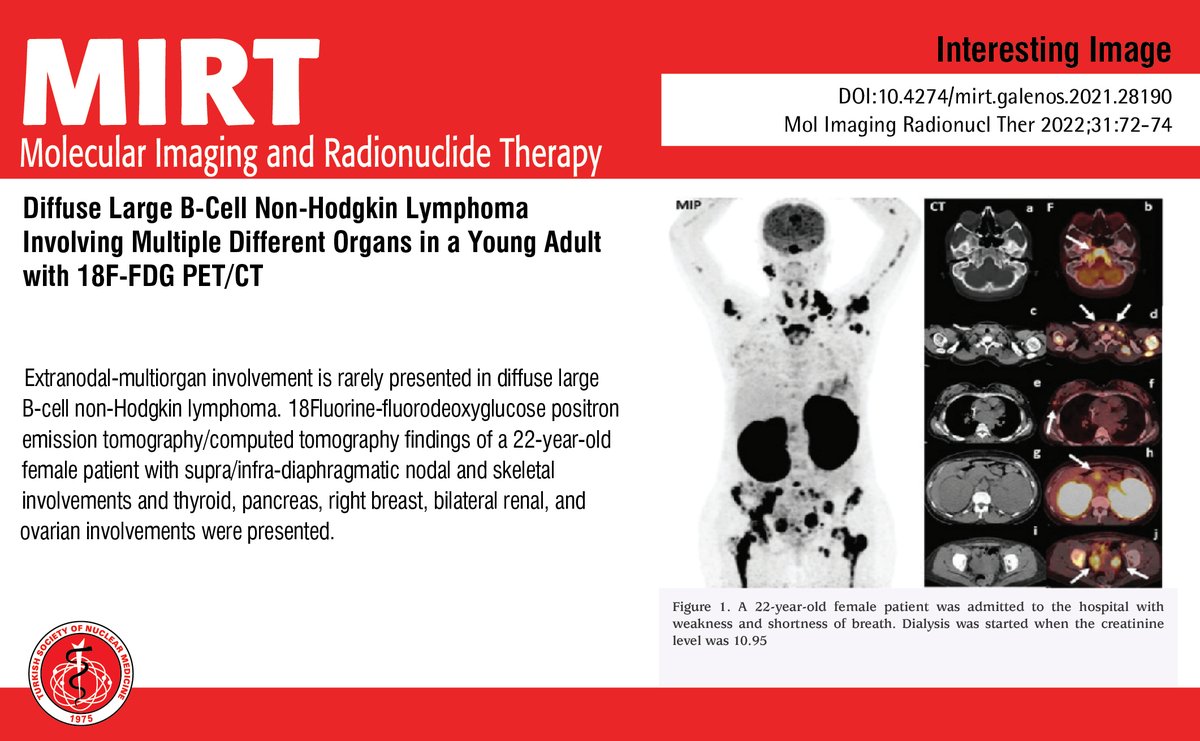 MIRTOfficial's tweet photo. Diffuse Large B-Cell Non-Hodgkin Lymphoma Involving Multiple Different Organs in a Young Adult with 18F-FDG PET/CT
You can see the free full text of the research by Esra Arslan et al.
Link: https://t.co/nyEhH3NHcC
#Extranodal #multiorgan #involvement #diffuselarge #Bcell https://t.co/NohpaFqrnu