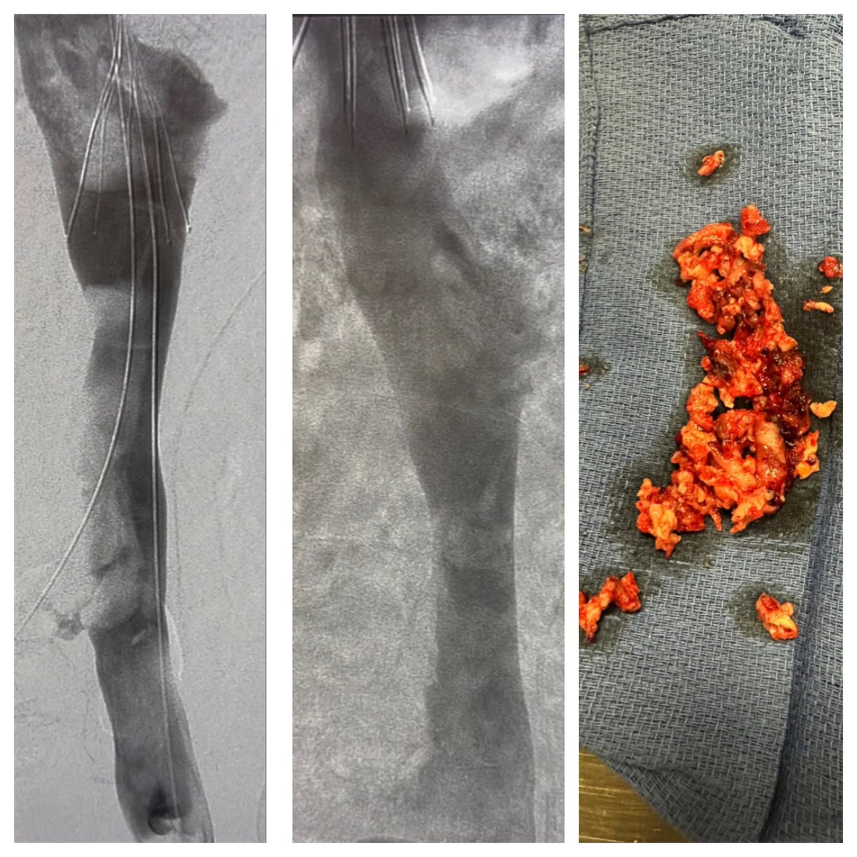 Columbia VIR (@columbiavir) on Twitter photo Patient with significant lower extremity swelling with #IVC thrombosis post single session mechanical thrombectomy using Lighting Flash, symptoms improved within 24 hrs
#irad #SIR #IRadRes #futureradres
<a href="/SIRspecialists/">Society of Interventional Radiology</a> <a href="/SIRRFS/">SIR RFS</a> <a href="/columbiaimaging/">Columbia Radiology</a> <a href="/columbiaradres/">Columbia Radiology Residents</a> <a href="/noorahmadmd/">Noor Ahmad</a> Patient with significant lower extremity swelling with #IVC thrombosis post single session mechanical thrombectomy using Lighting Flash, symptoms improved within 24 hrs
#irad #SIR #IRadRes #futureradres
<a href="/SIRspecialists/">Society of Interventional Radiology</a> <a href="/SIRRFS/">SIR RFS</a> <a href="/columbiaimaging/">Columbia Radiology</a> <a href="/columbiaradres/">Columbia Radiology Residents</a> <a href="/noorahmadmd/">Noor Ahmad</a>