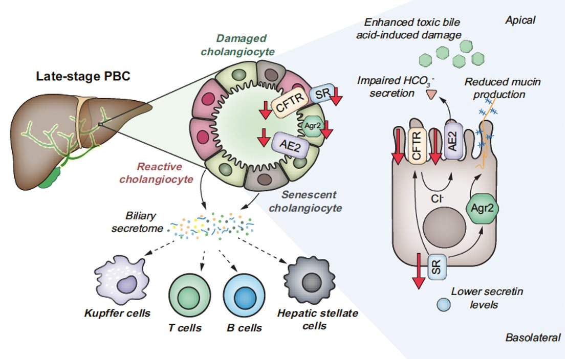 1/3🚀JHEP Twittorial🚀

☘️More insights on biliary secretory defects as primary cause of PBC🔓👉bit.ly/3T9ALv4

PBC👉cholestatic &amp; immune-mediated liver disease
⬇️secretin (SEC)-stimulated AE2 biliary HCO3- secretion
💊UDCA:⬆️SEC response
Alpini at al👇👇
#livertwitter