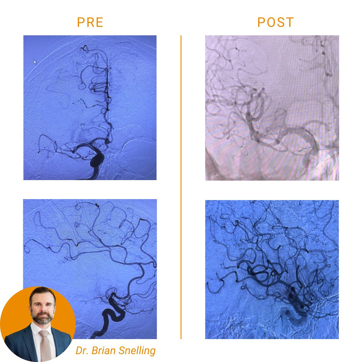 ImpCare_Stroke's tweet photo. First pass #TICI3 with #Zoom35, #Zoom71, and #Zoom88. Congratulations on an impressive full #ZoomStrokeSolution case, @snellingmd. Thanks for sharing.
Rx Only. ISI: https://t.co/9GLPGxFsrr https://t.co/rwowDYXiw5