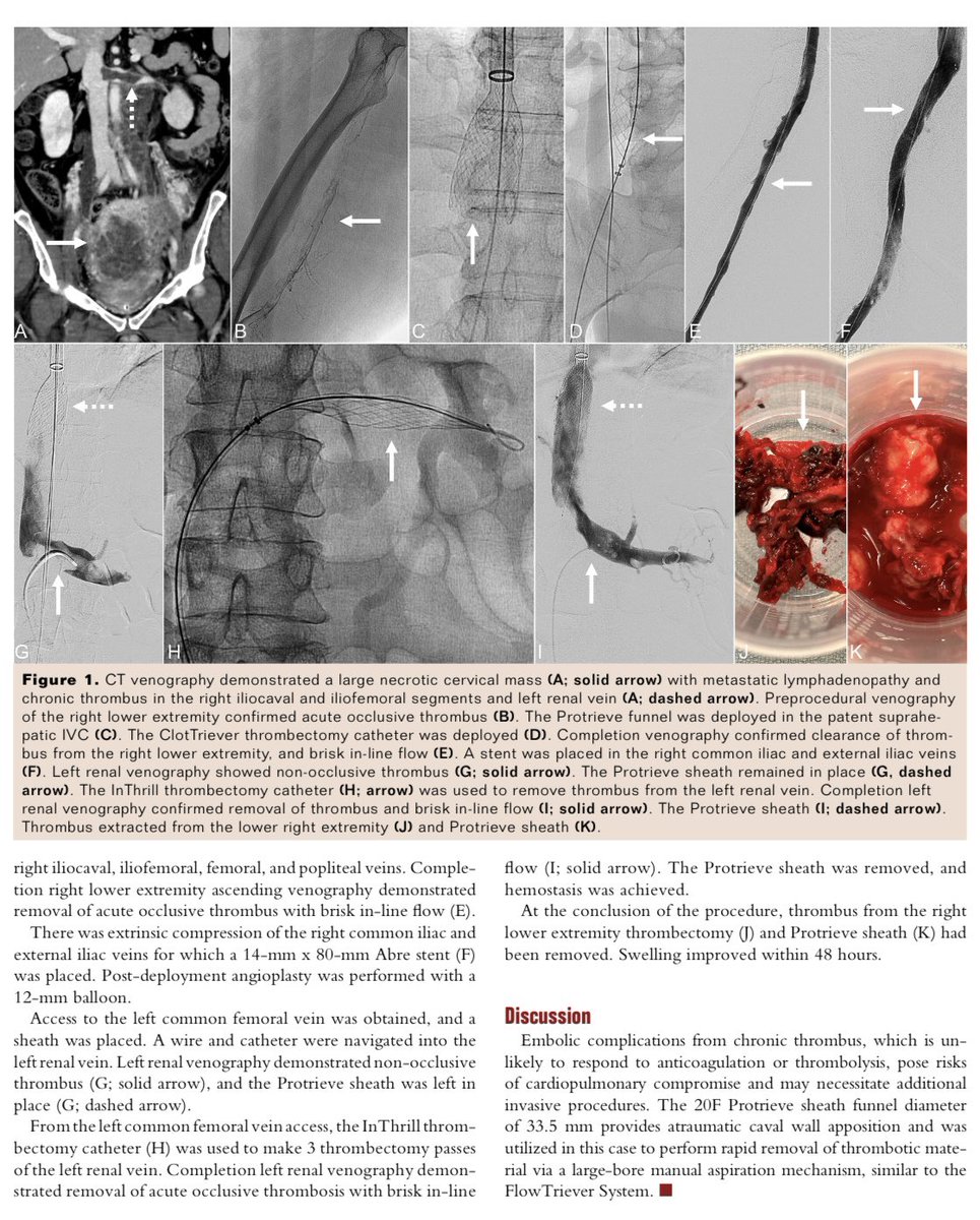Jeffrey F. B. Chick, MD, MPH (@chickvir) on Twitter photo The Protrieve Sheath provides atraumatic caval wall apposition for complete embolic capture and enables rapid removal of any captured embolic materials via a large-bore manual aspiration mechanism. <a href="/InariMedical/">Inari, now part of Stryker</a> <a href="/hmpVDM/">Vascular Disease Management</a> <a href="/UWRadiology/">UW Radiology</a> <a href="/UofWa_IR/">University of Washington IR Residency</a> The Protrieve Sheath provides atraumatic caval wall apposition for complete embolic capture and enables rapid removal of any captured embolic materials via a large-bore manual aspiration mechanism. <a href="/InariMedical/">Inari, now part of Stryker</a> <a href="/hmpVDM/">Vascular Disease Management</a> <a href="/UWRadiology/">UW Radiology</a> <a href="/UofWa_IR/">University of Washington IR Residency</a>