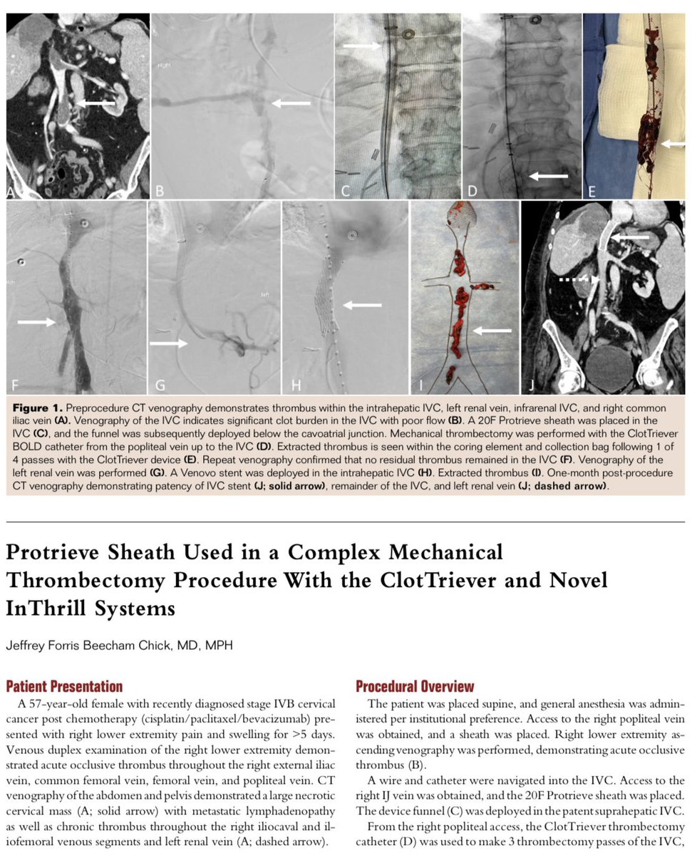 CHICKVIR's tweet photo. The Protrieve Sheath provides atraumatic caval wall apposition for complete embolic capture and enables rapid removal of any captured embolic materials via a large-bore manual aspiration mechanism. @InariMedical @hmpVDM @UWRadiology @UofWa_IR https://t.co/R6ig9oCRN3
