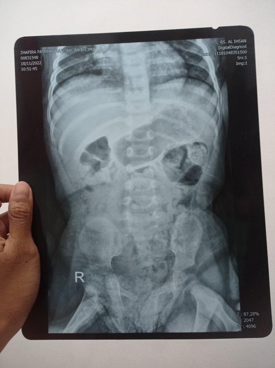 ignialfa28's tweet photo. @sosmedkeras Mohon bantuannya wrg twitter, sy sedang butuh dana utk operasi anak saya. Namanya zhafira, anak sy berusia 15bln dn mengalami pyloric stenosis (penyempitan pylorus). Zhafira hrs segera di OP tapi sy terhalang biaya. Do your magic twitter. sy mohon dgn kebaikan hati semuanya 🙏🥺 https://t.co/0PEO908IZh
