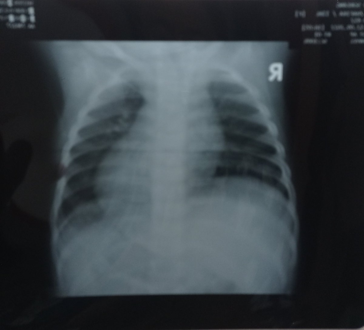 ignialfa28's tweet photo. @sosmedkeras Mohon bantuannya wrg twitter, sy sedang butuh dana utk operasi anak saya. Namanya zhafira, anak sy berusia 15bln dn mengalami pyloric stenosis (penyempitan pylorus). Zhafira hrs segera di OP tapi sy terhalang biaya. Do your magic twitter. sy mohon dgn kebaikan hati semuanya 🙏🥺 https://t.co/0PEO908IZh