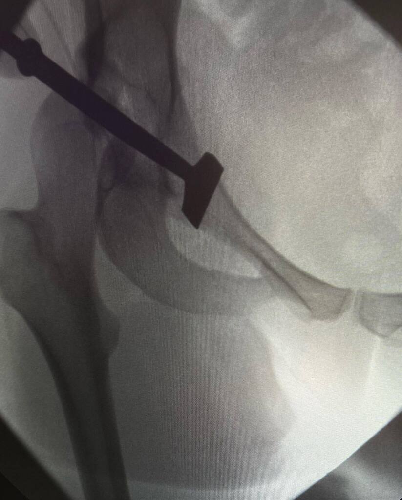 LuijoRN's tweet photo. Osteotomia periacetabular de Ganz mediante abordaje mini invasivo Trans-sartorial.
.
Ademas de la técnica habitual descrita por el profesor Ganz, y de las mejoras en relación a la técnica descrita por el Dr Söballe, utilización de recuperador de sangre, … https://t.co/xtya66YNyy https://t.co/DgxXhNkzAg