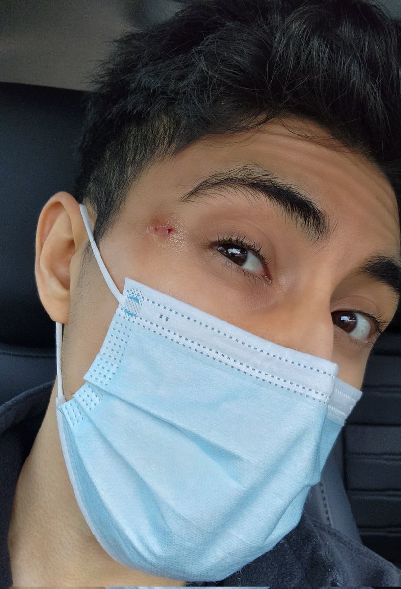 SLO on Twitter "Got my stitches removed"
