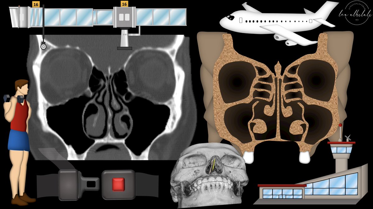 1/Time to FESS up! Do you understand functional endoscopic sinus surgery (FESS)? If you read sinus CTs, you must know what they’re doing to make the helpful findings Here’s a #tweetorial to help you! #medtwitter #meded #FOAMed #FOAMrad #radres #neurorad #HNrad #radtwitter