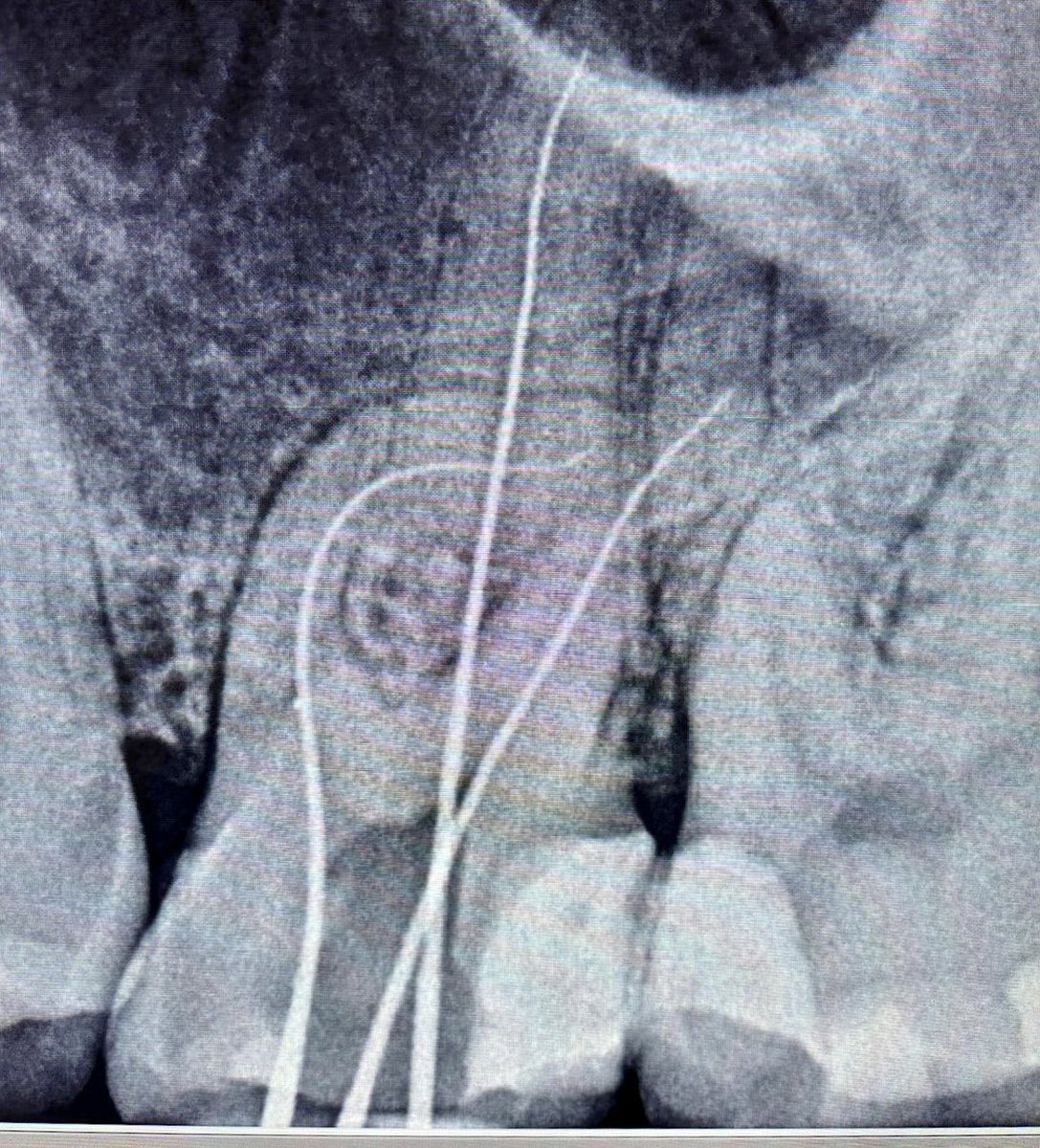 drpmdfuentes's tweet photo. Porque por muchas #curvas complicadas que tengas en la #vida siempre hay una #solucion 😎 #Endodoncia en #pieza26 hecha con la mejor #tecnologia y los mejores aliados en materiales @DentsplySirona 😉 en @_clinicadental
.
.
.
#xsmartiq #calamusdual #protapergold https://t.co/oIA1RcEpof