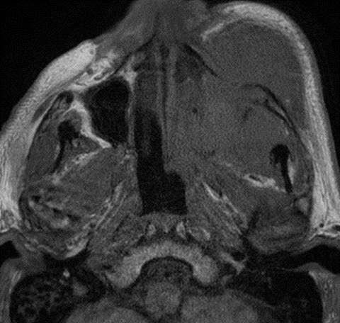 daniel_gewolb's tweet photo. 75 y/o M with progressive left face discomfort and enlargement over 2 weeks following dental extraction

Can you figure it out? Answer and additional images in thread 🧠 (apologies for the motion) 
#MedTwitter #Neurology #Neurosurgery #neurorad @ASHNRSociety @HeadNeckRads https://t.co/aHNha7vX7M