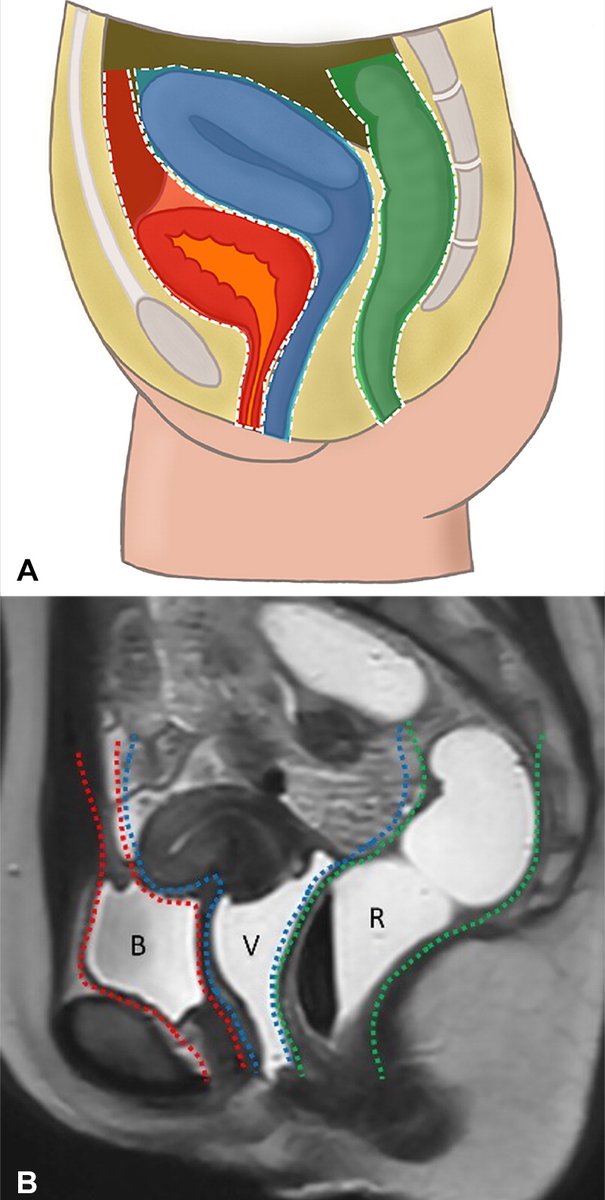 MR defecating proctography is a powerful tool for dynamic evaluation of pelvic anatomy & assessment of defecation. Let’s learn about basic concepts, techniques, & pathologic entities that contribute to posterior compartment disorders. bit.ly/3Cy2qij