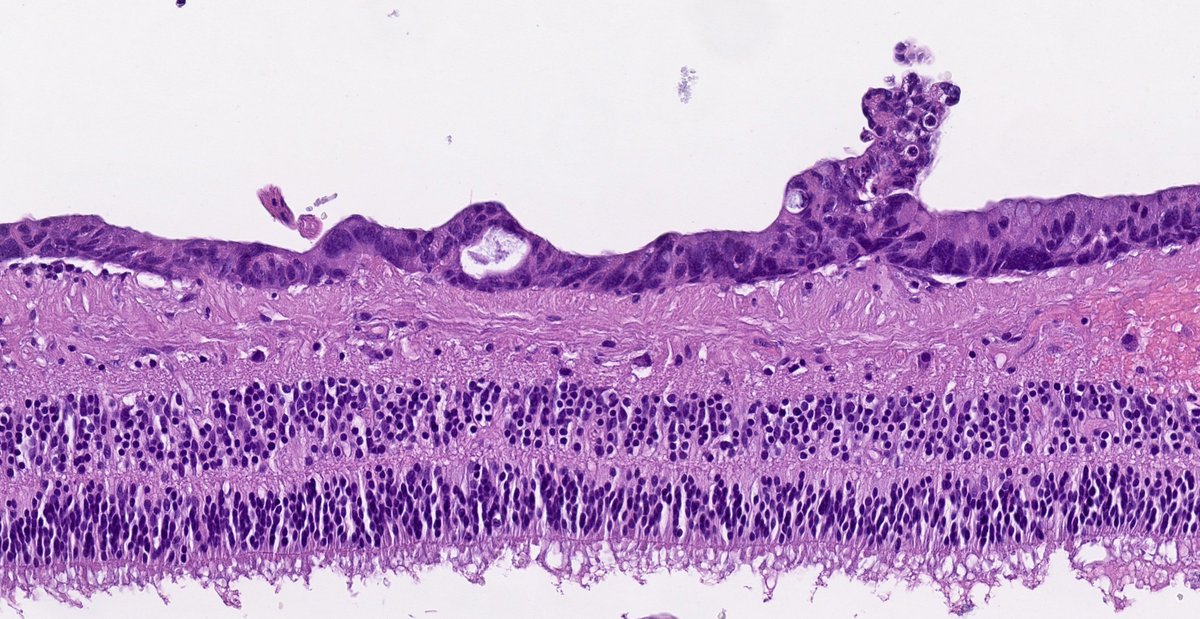 Jerad Gardner MD On Twitter RT AliaksZhur Ocular Metastasis Of jerad-gardner-md-on-twitter-rt-aliakszhur-ocular-metastasis-of