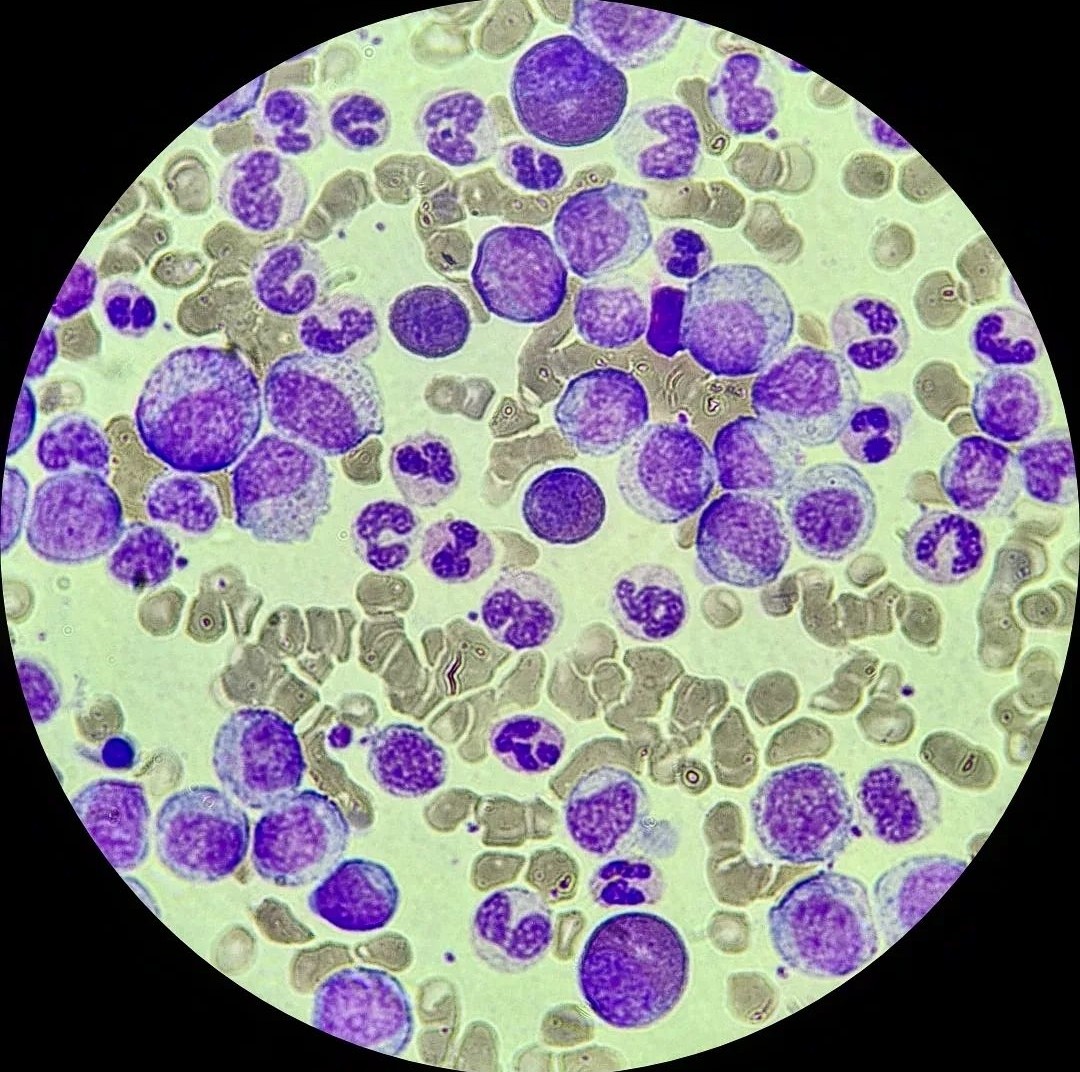 Leucemia Mieloide Crónica (LMC) 💜
WBC: 393,000