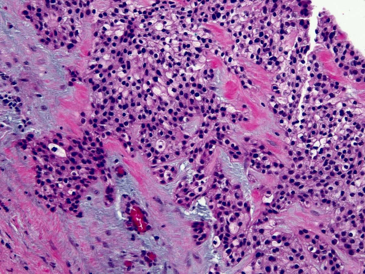 Clear cell carcinoma (hyalinizing clear cell carcinoma), lung: Rare salivary gland-type tumor with EWSR1::ATF fusion. Mimics the immunophenotype of squamous cell carcinoma! kikoxp.com/posts/19851