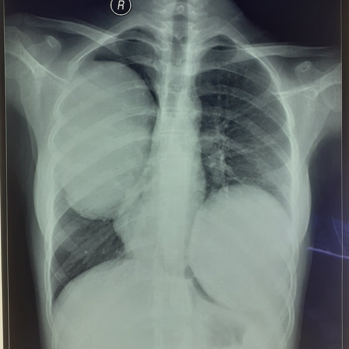 DrDatta_AIIMS's tweet photo. Female. 40 Y old. Presented with Mild Shortness Of Breath (Gradually Progressive). Differentials? Frontal Chest Radiograph was sent to our department for our comments! 
No Fever. No Cough. No other significant symptoms.

#MEDTWITTER #RADTWITTER https://t.co/e8mU2CJ4Dw