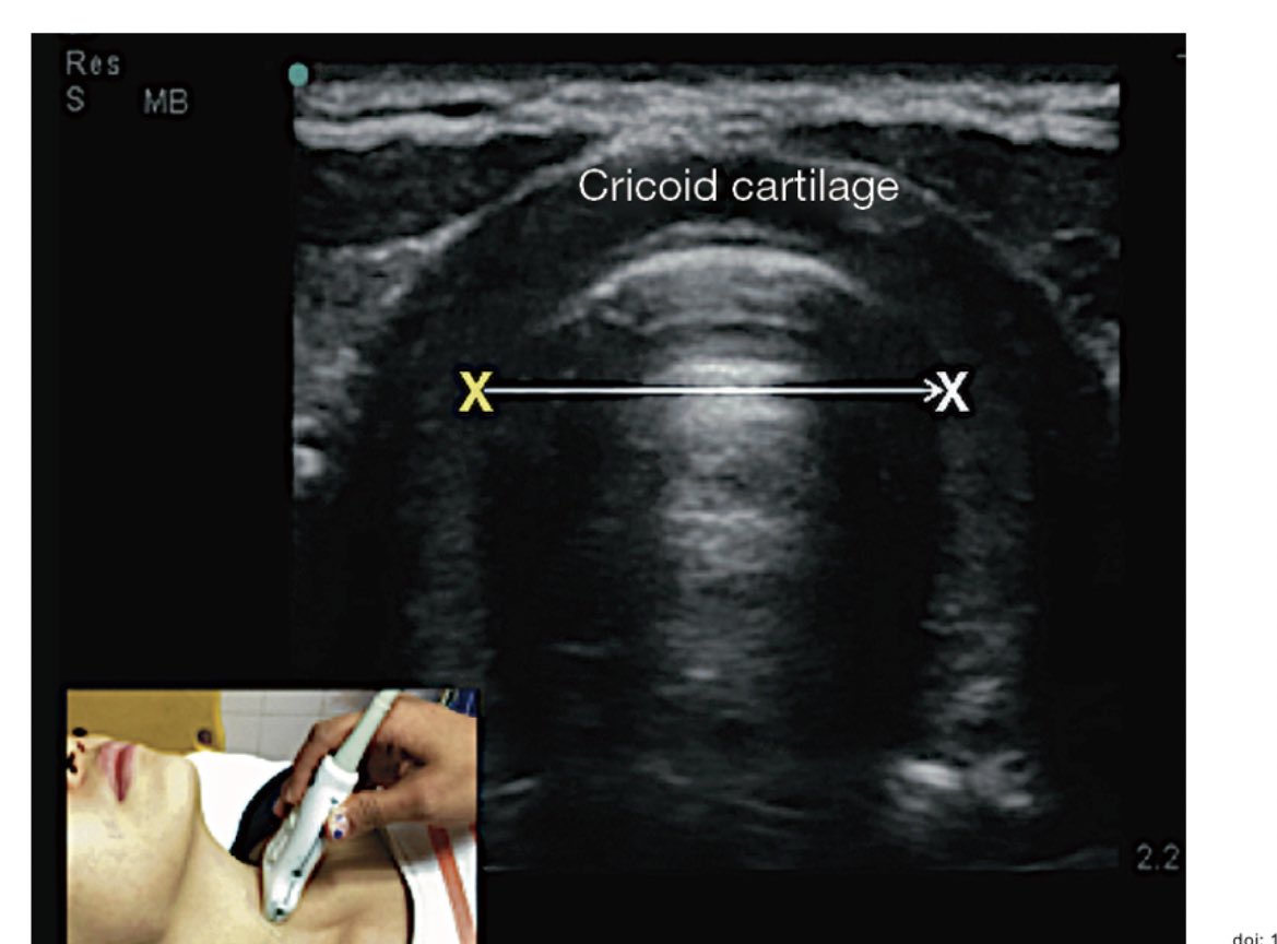 PRE-INTUBEISHON
1: Diámetro del columna de aire 🌬️ medir en ventana cricoidea. La distancia refleja el diámetro EXTERNO para el tubo! 📏 👁️ DOI: 10.21037/jeccm.2019.06.05