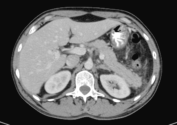 Recurrent Acute Pancreatitis: Dangerous Etiology?
by Jesús Espinel Diez, MD[ISSN 2471-142X]

Read the full article here: bitly.ws/xpDE

For manuscript submission click here: bit.ly/2Htkqj5

#openventio #openacess #openjournal #peerreviewed #medical #etiology