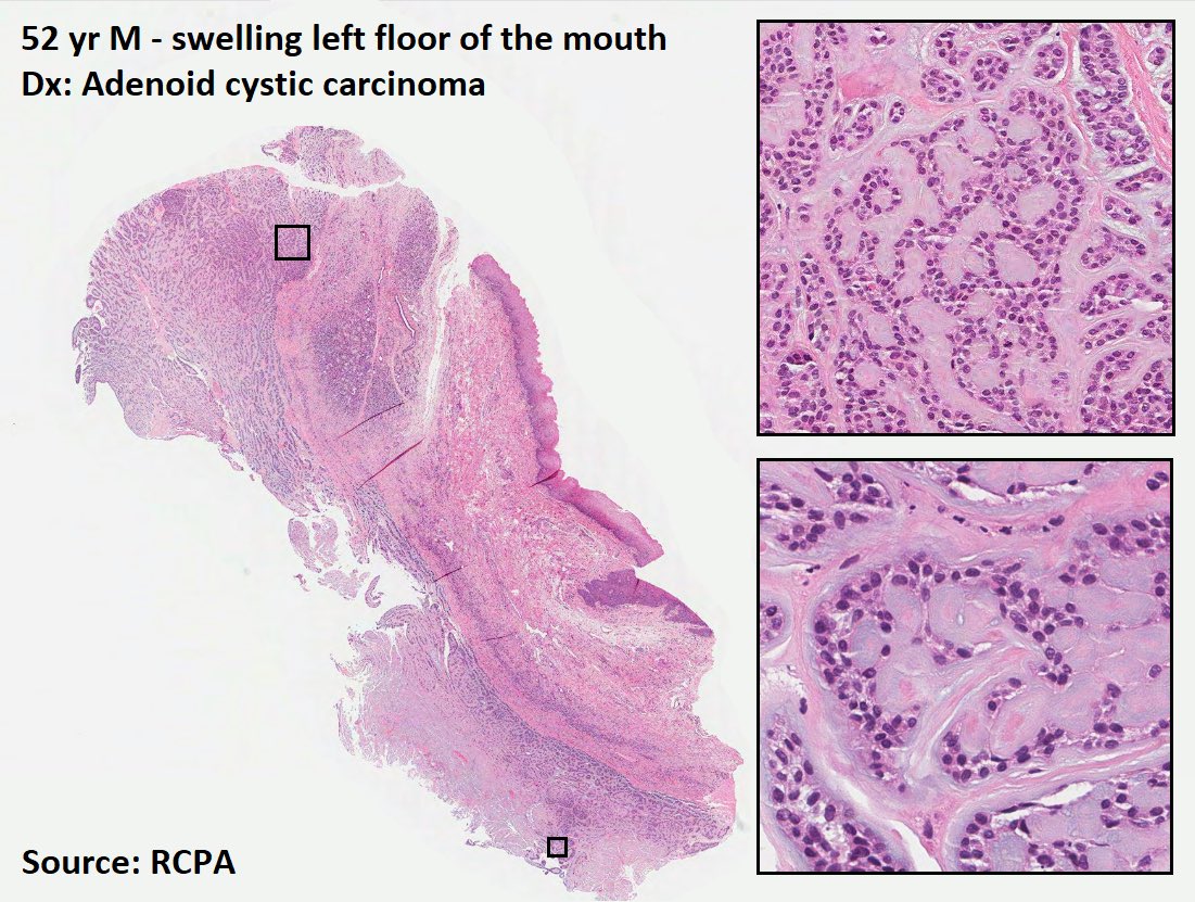 Histology flash card

Salivary: Adenoid cystic carcinoma (ACC)

Arises in both minor & major salivary glands
Most common major area affected: parotid

Freq Perineural invasion
Recurrences common

Prognosis
5 yr survival: 77%
15 yr: 45%
Most common site of Mets: lung

#PathOutPic