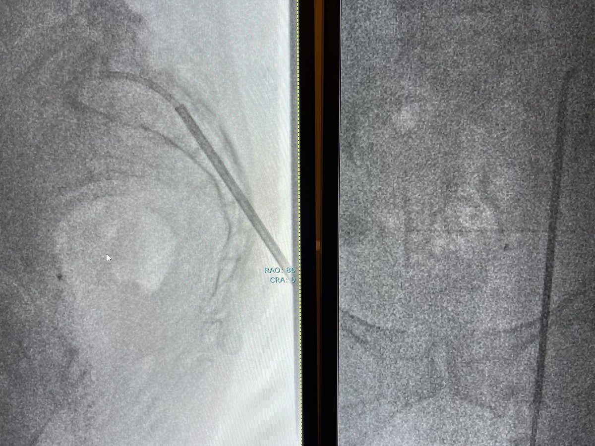 darthglader's tweet photo. Then place the needle between the foramina and the SI joint. 

Insert a curved introducer to get the the anterior superior sacrum. 

#fillgoals with a little bit of inadvertent cement in the SI joints. 

Patient’s pain is much better. No neuro deficits. 

#DontAtMeAboutExtrav https://t.co/QiGjCvXQuR