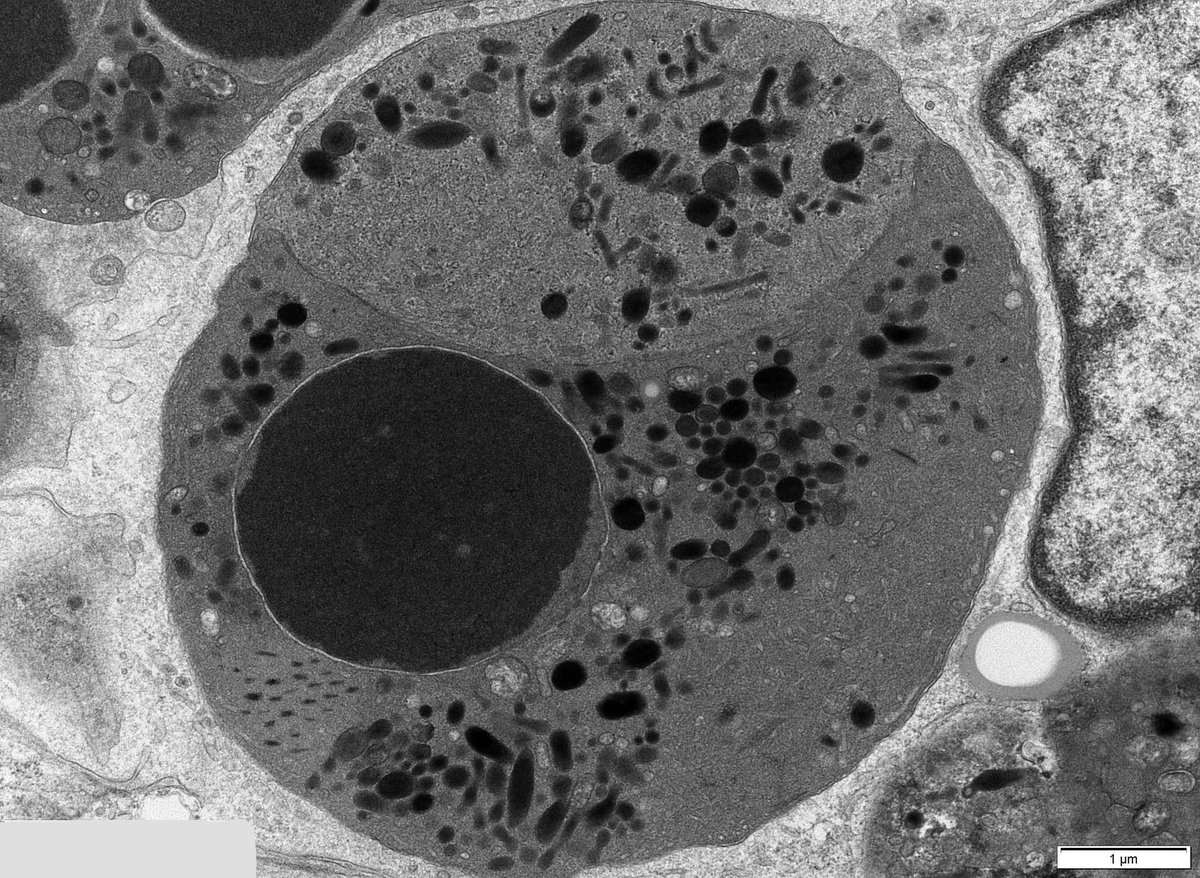JohnBrealey's tweet image. Renal Bx. Interesting neutrophils in glomerular capillary loops. Patient is positive for myeloperoxidase (MPO) autoantibodies. I interpret this as neutrophil apoptosis (#NETosis). But I don&apos;t see any extracellular traps (NETs). Are NETs visible by electron microscopy?
#askrenal