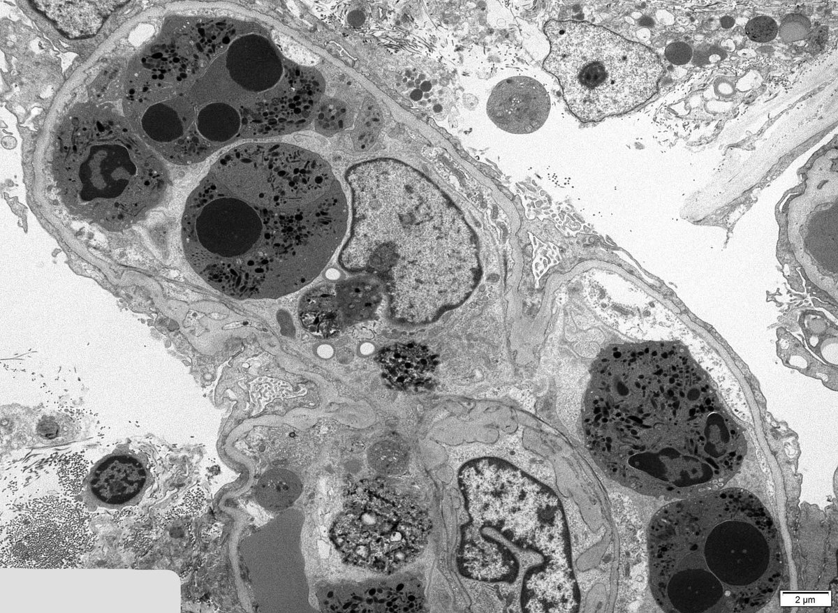 JohnBrealey's tweet image. Renal Bx. Interesting neutrophils in glomerular capillary loops. Patient is positive for myeloperoxidase (MPO) autoantibodies. I interpret this as neutrophil apoptosis (#NETosis). But I don&apos;t see any extracellular traps (NETs). Are NETs visible by electron microscopy?
#askrenal