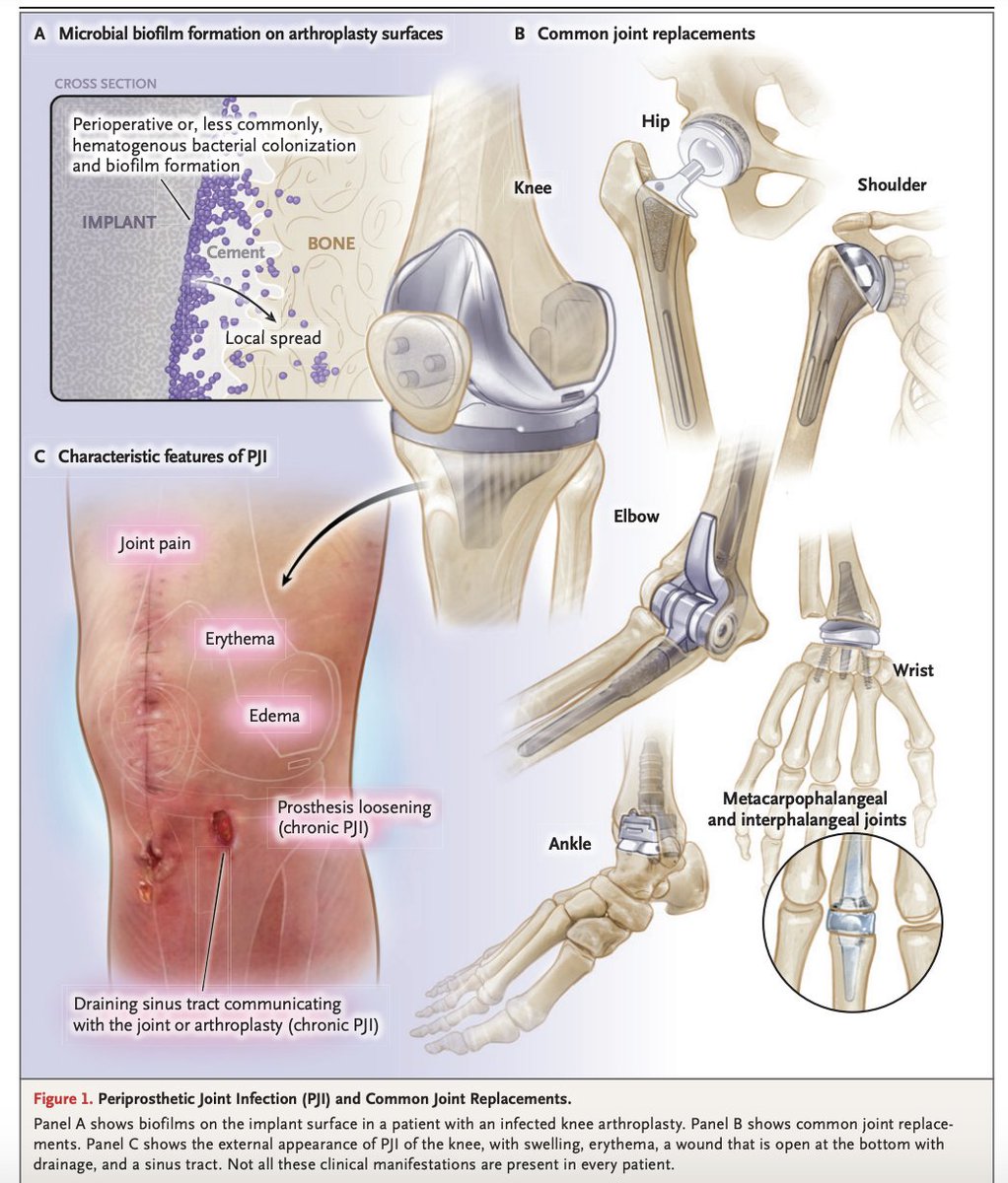 TakaMatsuo_ID's tweet photo. 【Periprosthetic Joint Infection】NEJM, Jan 19 2023
A great review of PJI has been just published!

👉A must-read for #IDFellows!!

@NEJM @MayoClinicINFD @mayocliniclabs @micro_rp 
#PJI https://t.co/EXKRqMIzPc