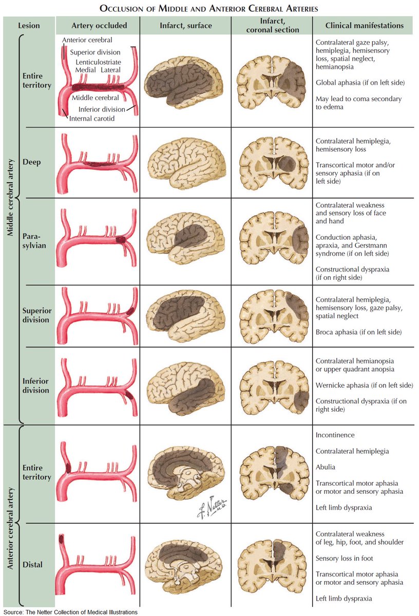 ManualOMedicine's tweet photo. Clinical Manifestations of Middle and Anterior Cerebral Artery Occlusion

#medtwitter #foamed #meded #Neurology https://t.co/YDvtb7fQYf