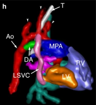 Lots to love in the new February 2023 issue now online! Intussusception, pediatric renal tumors, newborn fat necrosis & more to learn link.springer.com/journal/247/vo… Including 4D fetal cardiac MRI of congenital heart disease link.springer.com/article/10.100… Oblique recon normal fetal cardiac