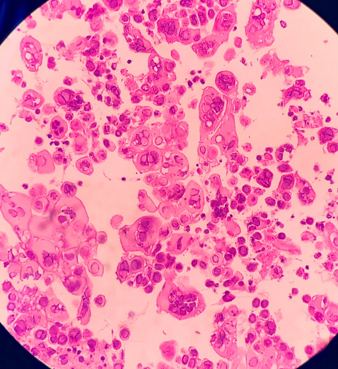 ArezuRhn (@arezurhn) on Twitter photo A 50-year-old woman, known case of metastatic breast cancer
Endoscopy shows multiple ulcers in esophagus
DDx: Herpes simplex esophagitis
#TUMS
#pathology #PathTwitter A 50-year-old woman, known case of metastatic breast cancer
Endoscopy shows multiple ulcers in esophagus
DDx: Herpes simplex esophagitis
#TUMS
#pathology #PathTwitter