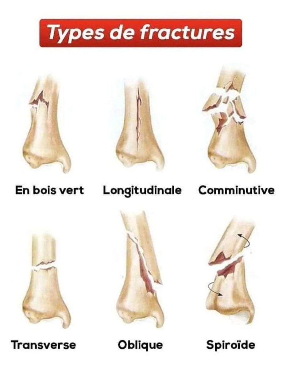 Rappel sur les généralités en Traumatologie !!