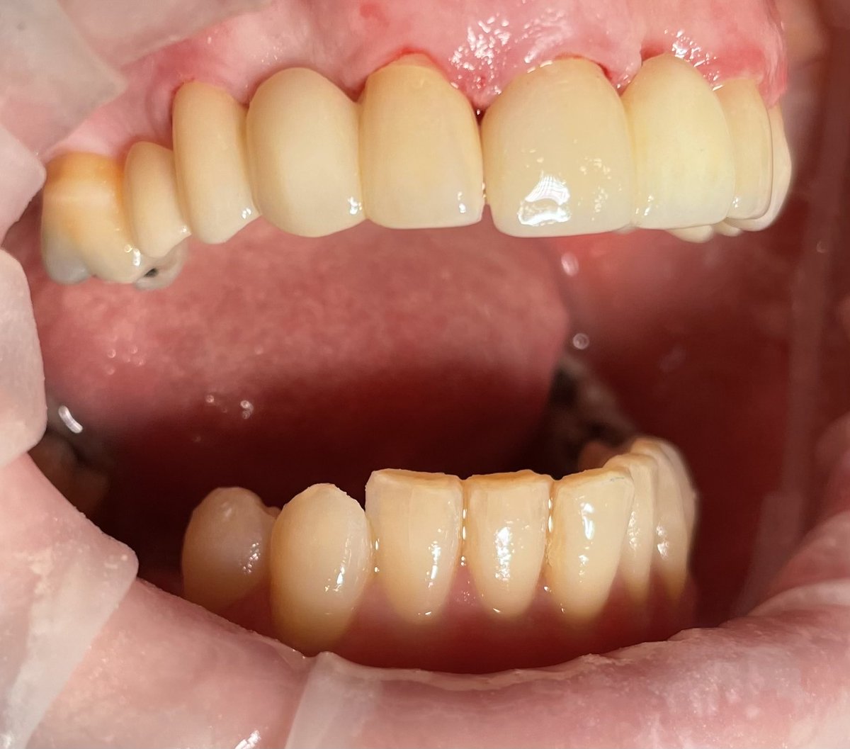A nice case involving multiple missing teeth replaced with fixed #ZirconiaBridges. Two weeks start to finish. A new smile that looks, feels and works just like your own teeth. 
#smiledesign #smilemakeover