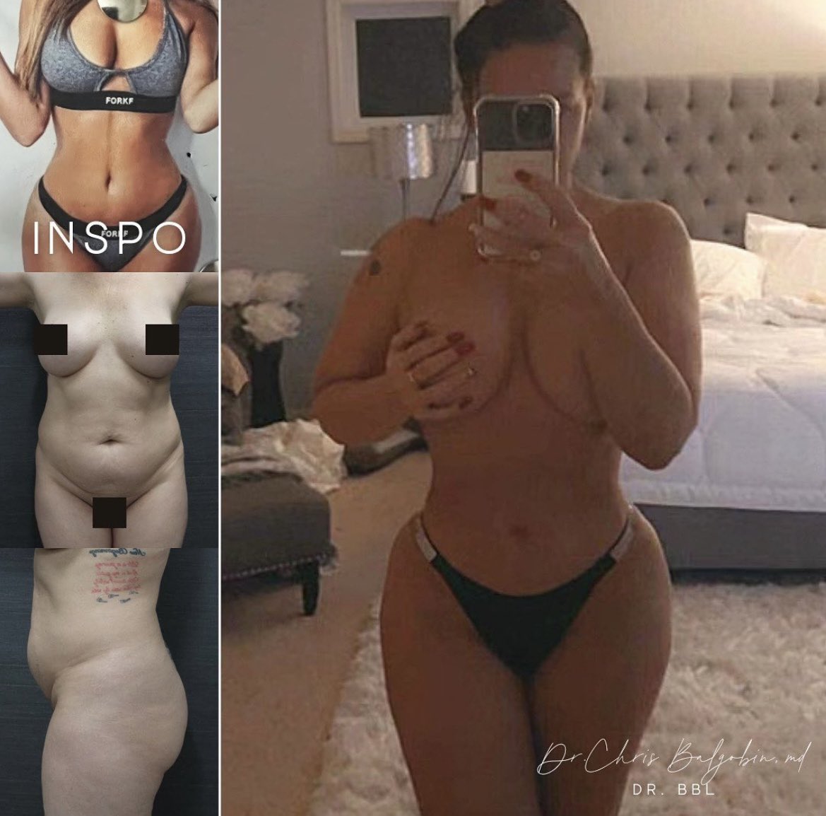 DoctorBalgo's tweet photo. 46 year old 5'5" Balgobin beauty is 5 months post-op vaser assisted, Lipo360 with BBL🍑 and Jplasma skin-tightening to the abdomen and back. #drbbl #doctorbalgobin #bbl #lipo #Jplasma #mncosmetics https://t.co/APXYUPsPs3