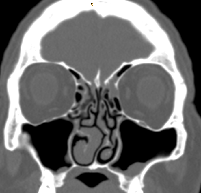 DrScottFortune's tweet photo. 54 yo M complains of nasal obstruction, recurrent sinus infections, and pressure over left eye. Diagnosis? Management? #Rhinology #Imaging #SinusCTscan #CRSwNP #OsseousLesions #chronicsinusitis #nasalpolyps https://t.co/rxfzkEgmjT