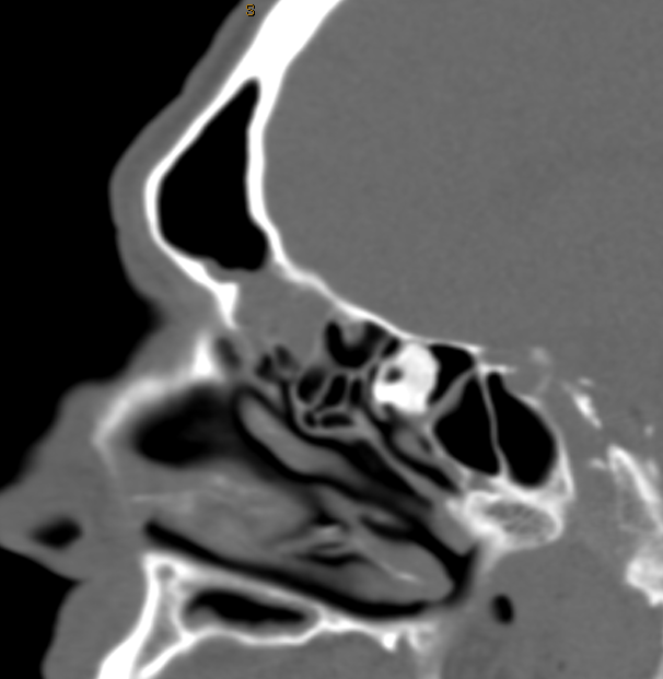 DrScottFortune's tweet photo. 54 yo M complains of nasal obstruction, recurrent sinus infections, and pressure over left eye. Diagnosis? Management? #Rhinology #Imaging #SinusCTscan #CRSwNP #OsseousLesions #chronicsinusitis #nasalpolyps https://t.co/rxfzkEgmjT