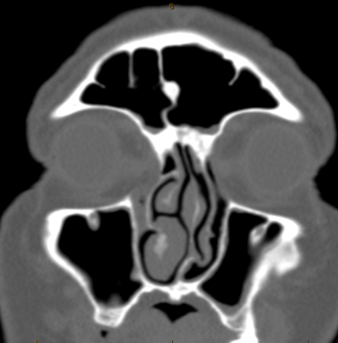DrScottFortune's tweet photo. 54 yo M complains of nasal obstruction, recurrent sinus infections, and pressure over left eye. Diagnosis? Management? #Rhinology #Imaging #SinusCTscan #CRSwNP #OsseousLesions #chronicsinusitis #nasalpolyps https://t.co/rxfzkEgmjT