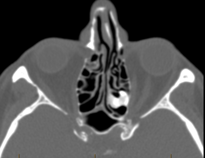 DrScottFortune's tweet photo. Additional view for your review #Rhinology #Imaging #SinusCTscan #CRSwNP #OsseousLesions #chronicsinusitis #nasalpolyps #RhinologyClinic https://t.co/SGWIKJf0SX