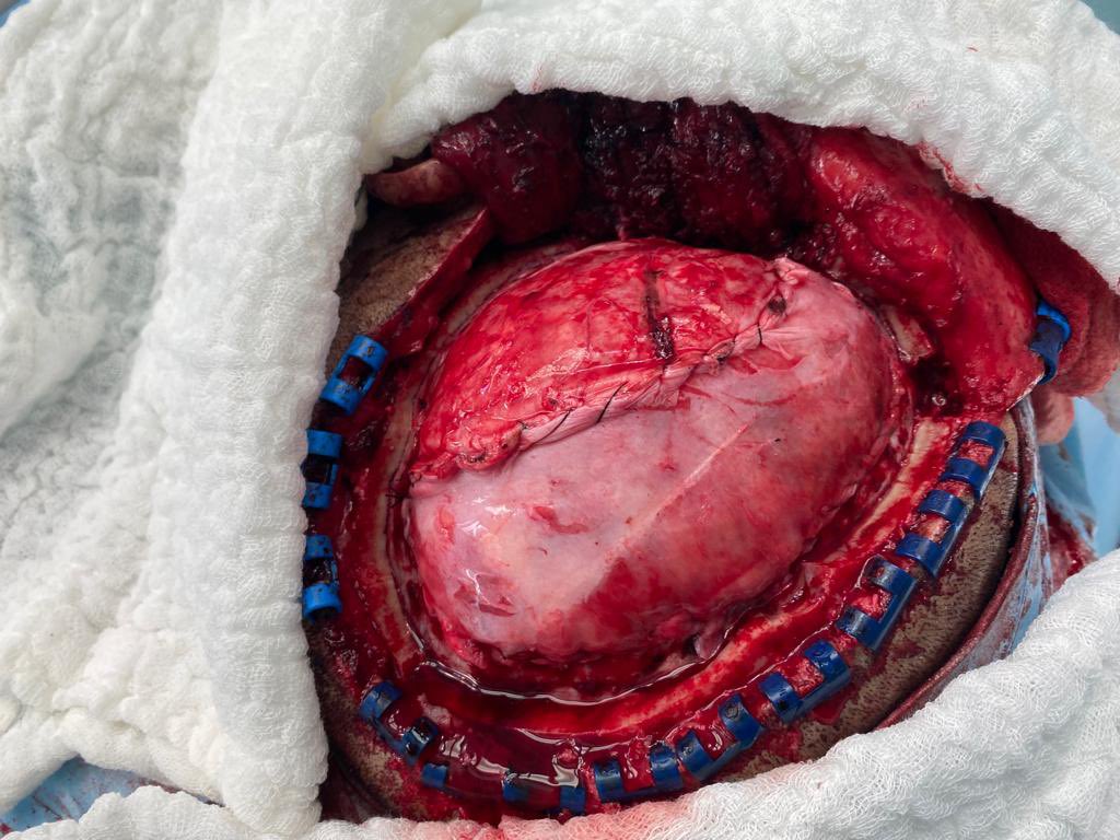 eerch33's tweet photo. Craniectomía descompresiva en paciente con ACV isquémico de la arteria cerebral media izquierda https://t.co/9rkAbluoMQ
