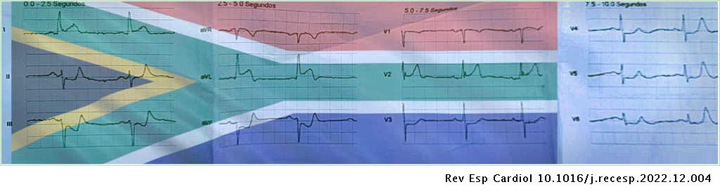 IAMCEST lateral alto con signo de la bandera de Sudáfrica #REC #AheadOfPrint revespcardiol.org//es-iamcest-la…