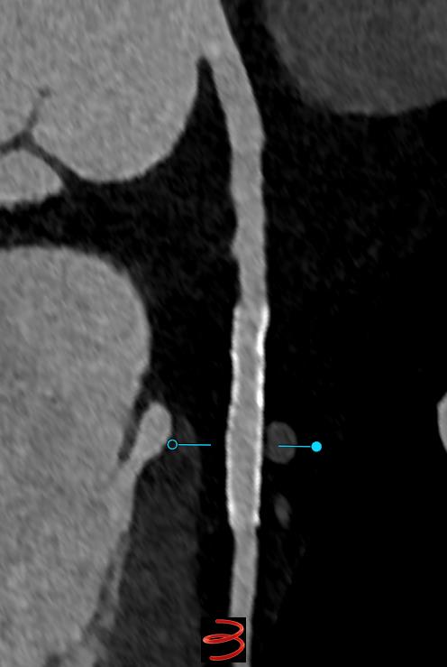 Omar Khalique (@okhaliquemd) on Twitter photo Ultra-high resolution #yesCCT imaging from the Naeotom Alpha. 0.2 mm recon , Bv56 kernel. No need for invasive angiography. <a href="/StFrancis_LI/">St. Francis Hospital & Heart Center</a> <a href="/Heart_SCCT/">Heart_SCCT</a> <a href="/onco_cardiology/">Juan Lopez-Mattei, MD</a> <a href="/DrRyanPDaly/">Ryan P. Daly, MD</a> <a href="/purviparwani/">Dr. Purvi Parwani</a> <a href="/AChoiHeart/">Dr Andrew D. Choi</a> <a href="/AkhilNarangMD/">Akhil Narang, MD</a> Ultra-high resolution #yesCCT imaging from the Naeotom Alpha. 0.2 mm recon , Bv56 kernel. No need for invasive angiography. <a href="/StFrancis_LI/">St. Francis Hospital & Heart Center</a> <a href="/Heart_SCCT/">Heart_SCCT</a> <a href="/onco_cardiology/">Juan Lopez-Mattei, MD</a> <a href="/DrRyanPDaly/">Ryan P. Daly, MD</a> <a href="/purviparwani/">Dr. Purvi Parwani</a> <a href="/AChoiHeart/">Dr Andrew D. Choi</a> <a href="/AkhilNarangMD/">Akhil Narang, MD</a>