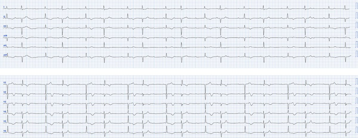 82 y.o. Female, presents with  fatigue, dyspnea and syncope.

What does her ECG show?

#FOAMed #CardioTwitter
#ECGchallenge #ECG #Cardiology @LopezLizarraga_  @AlejandroAG_MD  @PerezOrpinel @mdcv01 @Yldifonso777  @dr_ezquerra  @diegocamposfr  @EPeeps_Bot