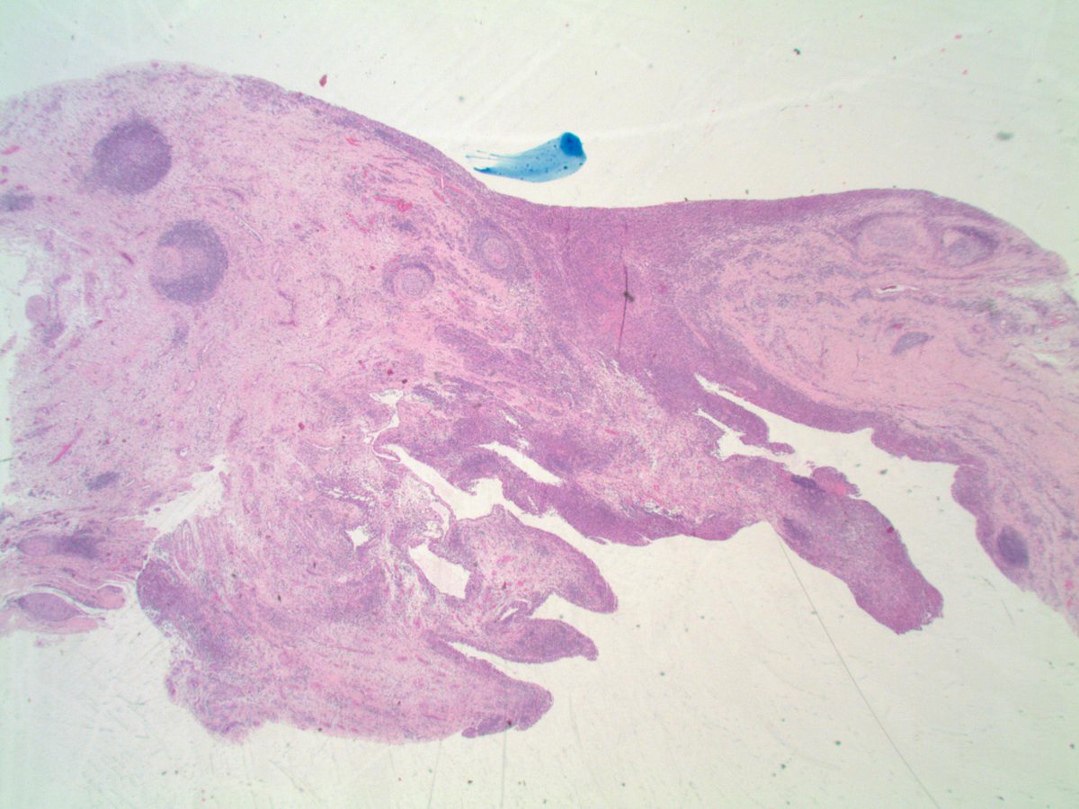 slusagar's tweet image. found this lil' treat while cleaning up my office:

knee synovium:  Cocci!😲#IDpath