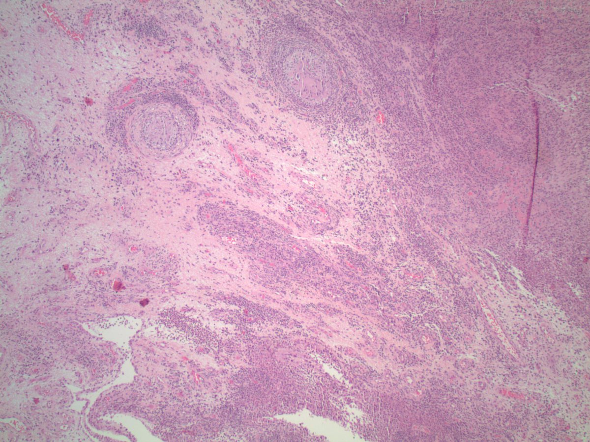 slusagar's tweet image. found this lil' treat while cleaning up my office:

knee synovium:  Cocci!😲#IDpath